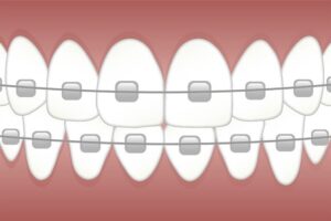 Why are Dental Braces So Expensive?